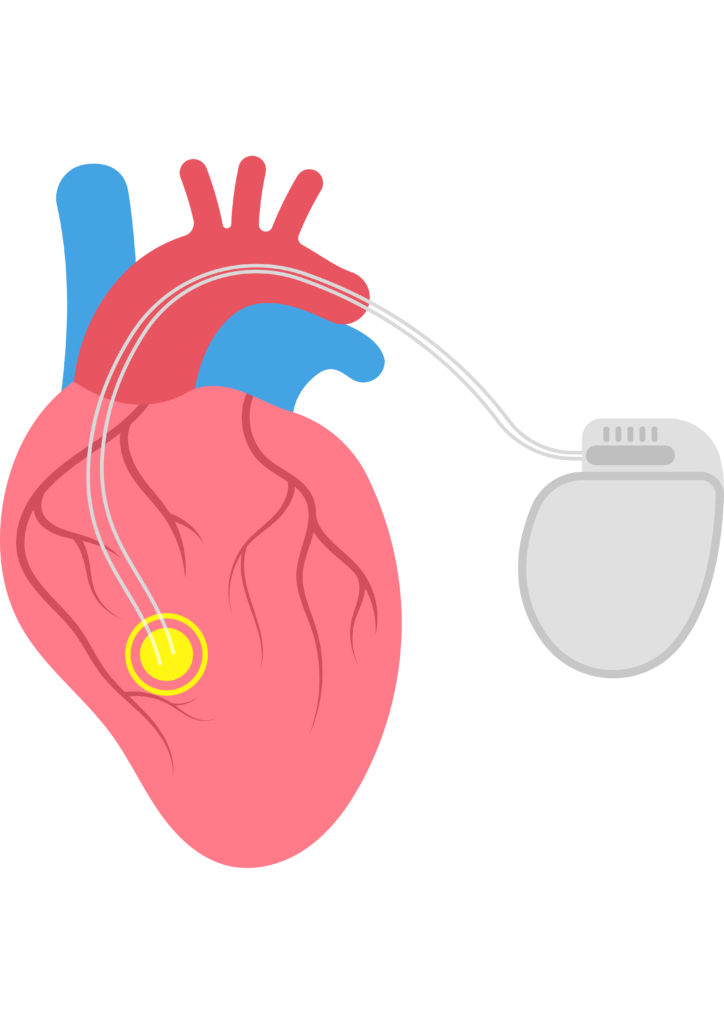 A pacemaker is a medical device that stimulates the heart to contract at a regular rate.